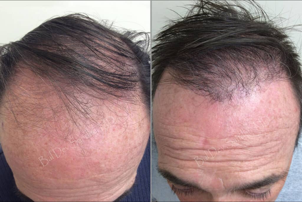 before after fue hair restoration