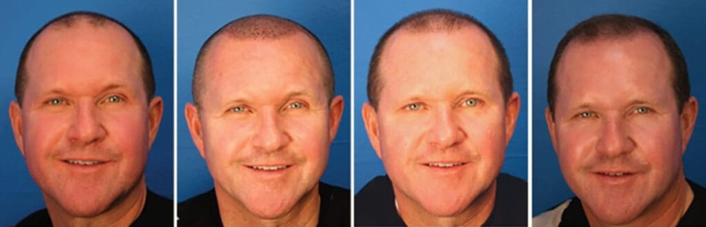before after fue Hair restoration