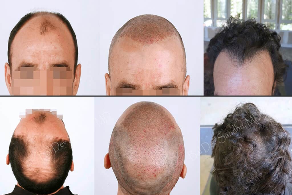 Before and After Hair Transplant Patients