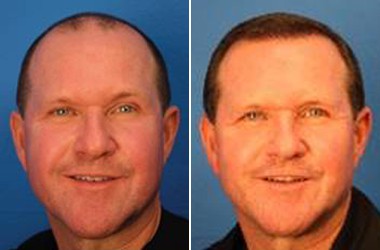 Patient before and after hair transplant