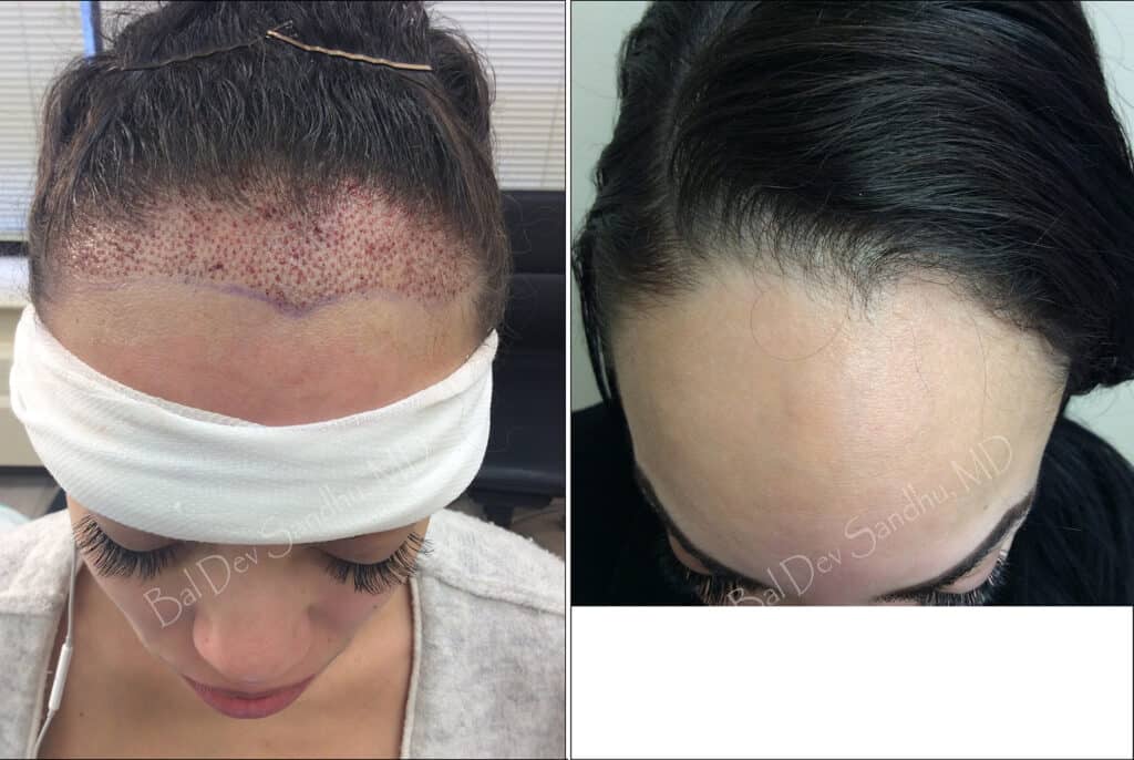 woman hair transplan before after