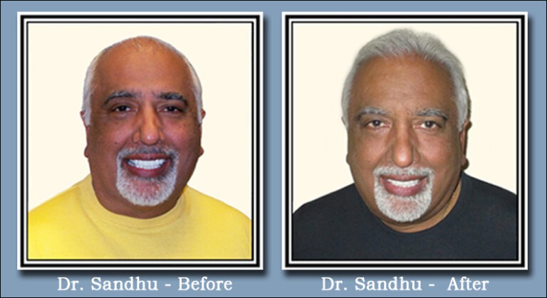 Dr Sandhu Before After Hair Transplant